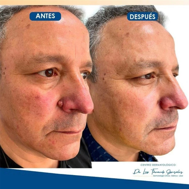 Liquido idratante per la rimozione delle verruche del viso