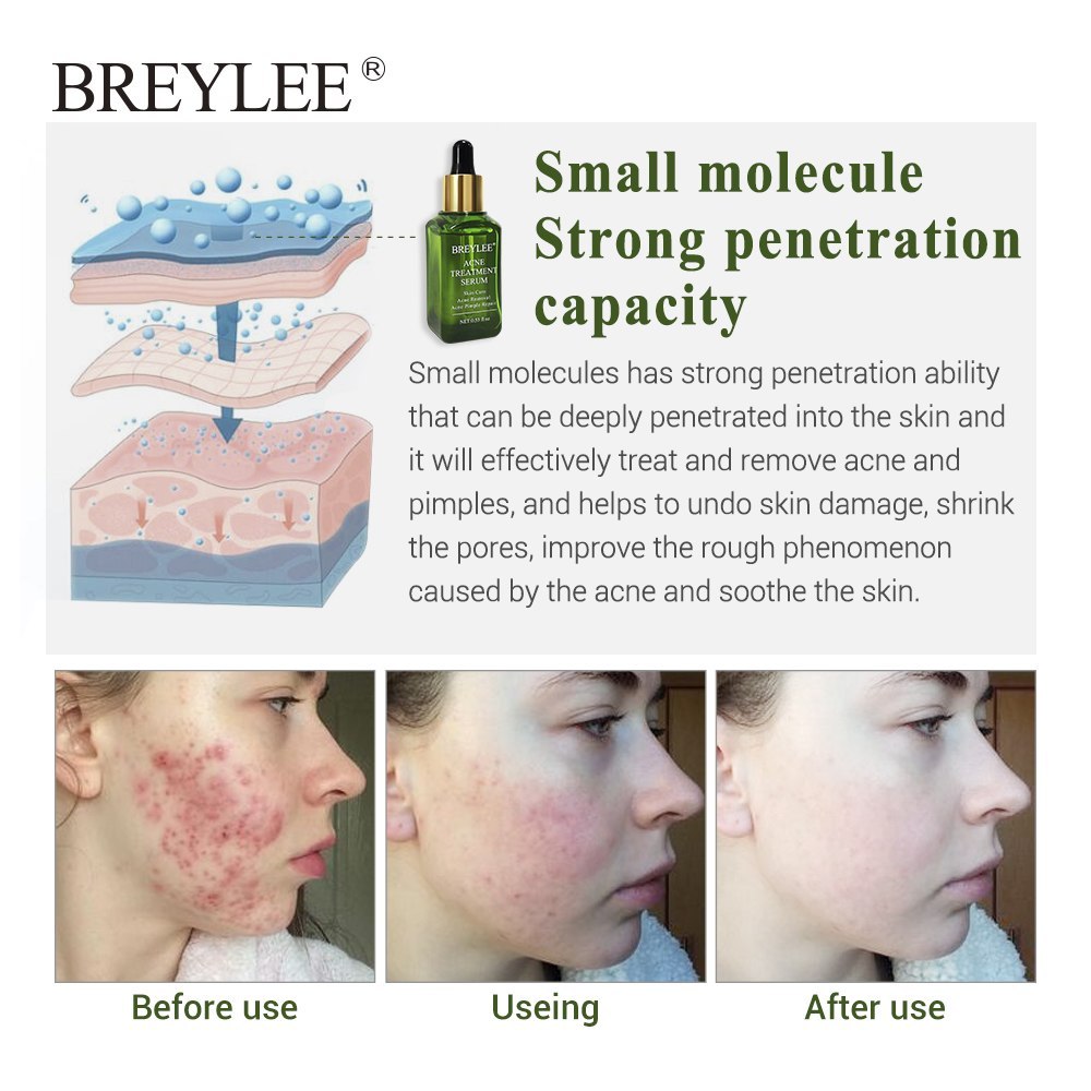 Acne Treatment Serum Face Facial Anti Acne Scar Removal Cream Skin Care Whitening Repair Pimple Remover For Acne